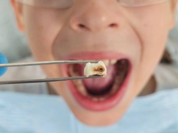 Best Emergency Wisdom Teeth Removal in East Vineland, NJ